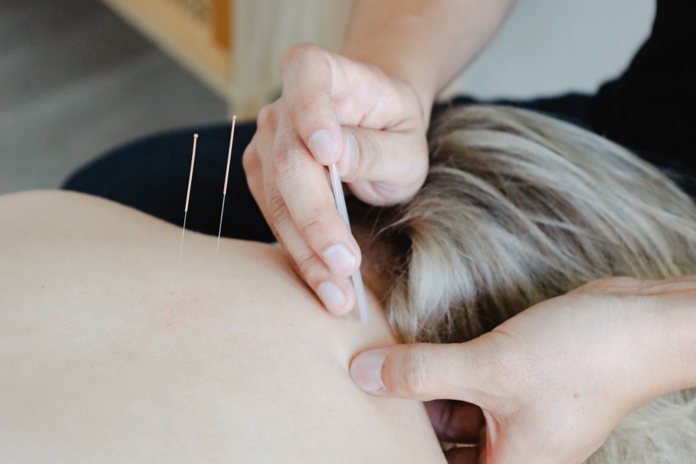 The Science of Dry Needling
